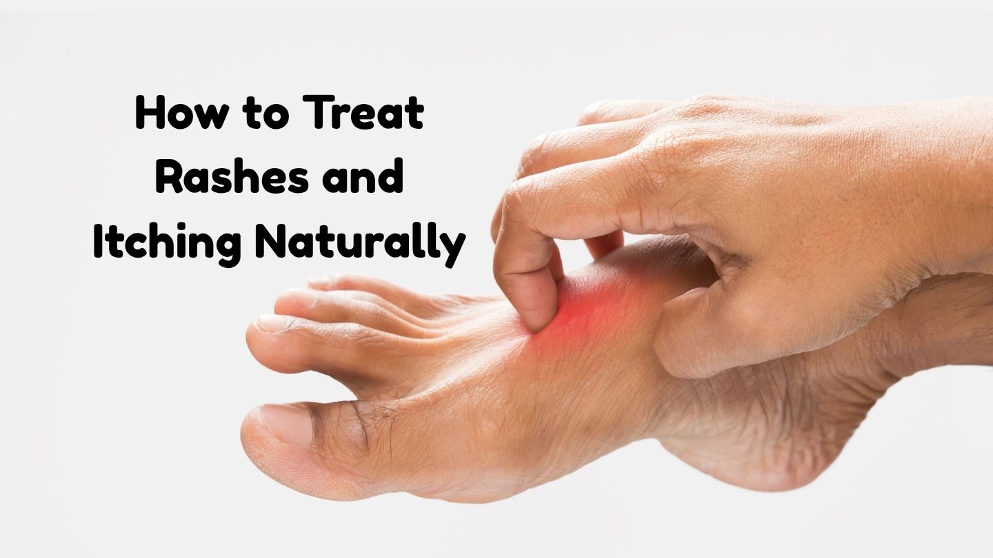 How to Treat Rashes and Itching Naturally