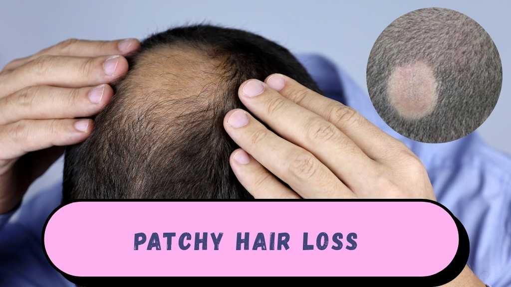 Person looking in a mirror with a worried expression, touching areas of thinning or patchy hair on their scalp, illustrating hair loss linked to immune system problems.