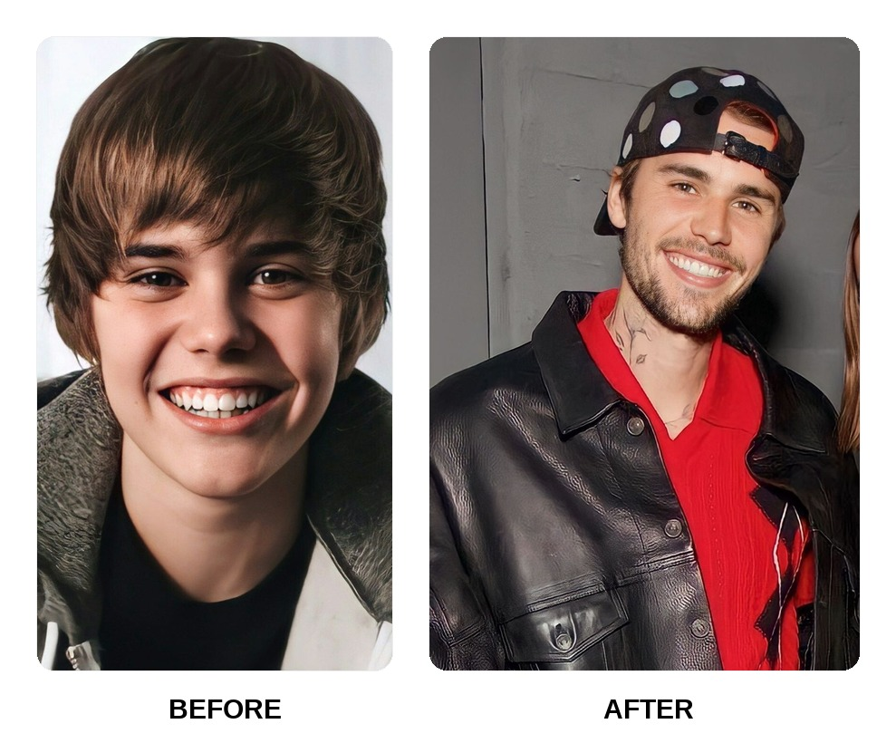 Justin Bieber started wearing Invisalign when he was a teenager