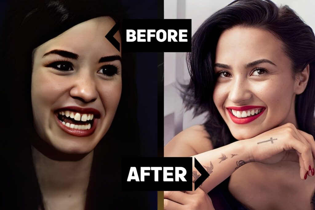 Demi Lovato used Invisalign to close the gap between her two front teeth