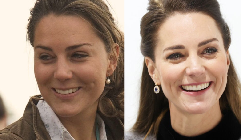 Kate Middleton wore Invisalign for six months