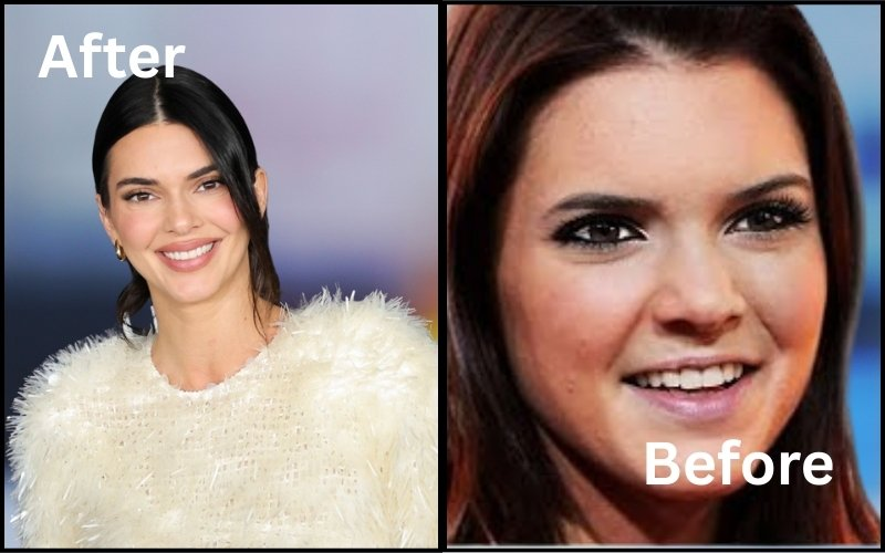 Kendall Jenner used Invisalign