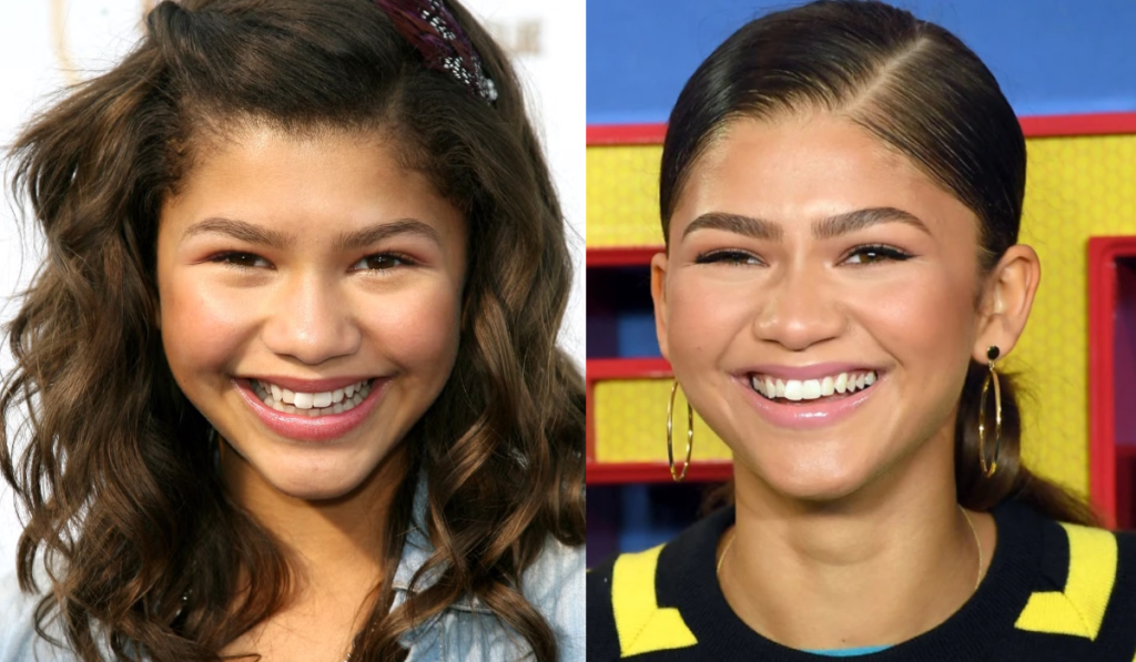 Zendaya began Invisalign at the age of 14