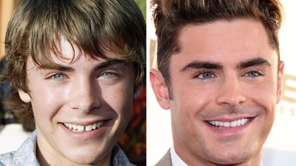 Zac had a noticeable gap between his front teeth