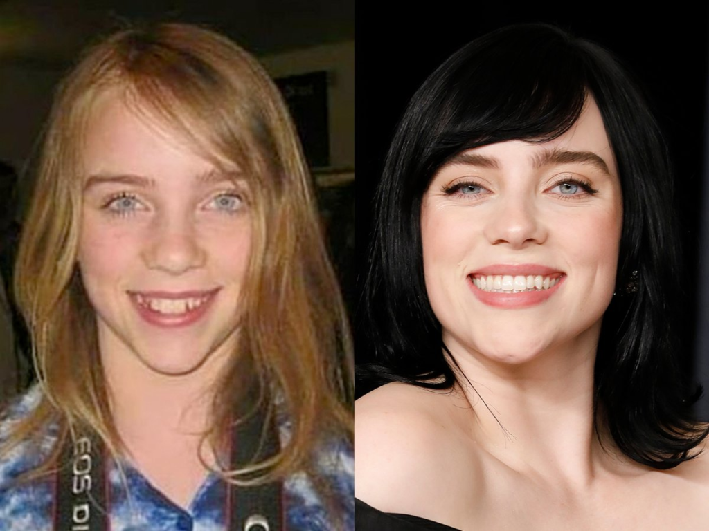 Billie Eilish wore Invisalign