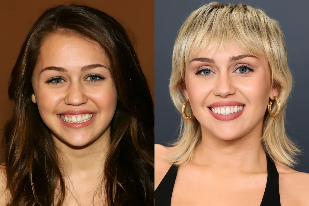 Miley Cyrus started Invisalign in 2018