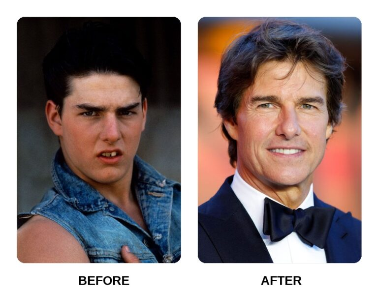Tom Cruise was one of the first big Hollywood stars to try Invisalign